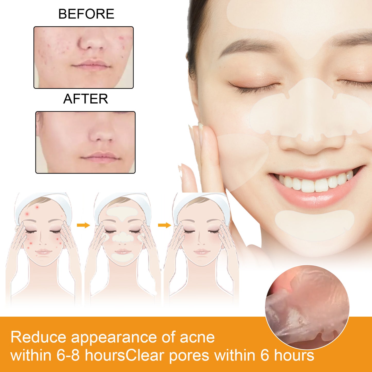 EELHOE Hydrogel Facial Acne Sticker