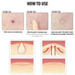 Acne Patch Skin Tags