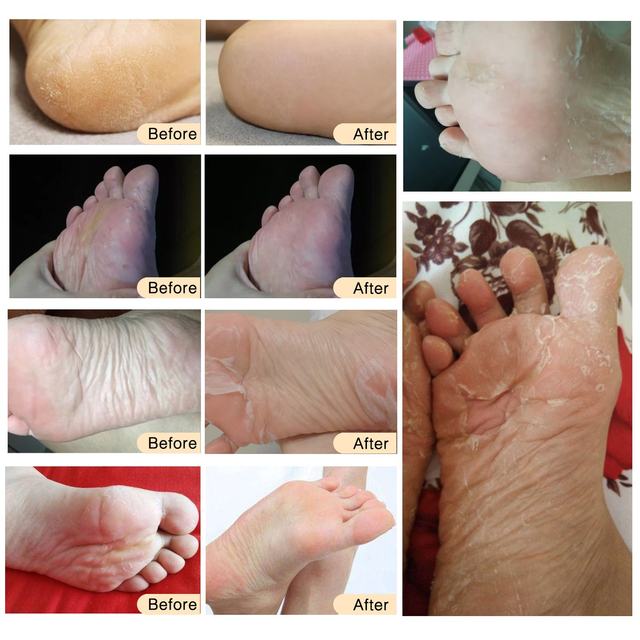 ALIVER dead skin calluses foot mask